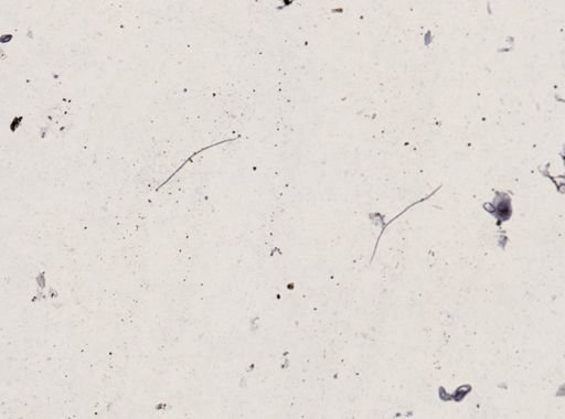 Onchocerca volvulus