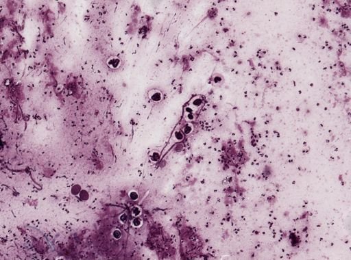 Onchocerca volvulus