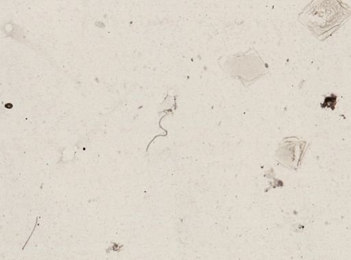Onchocerca volvulus