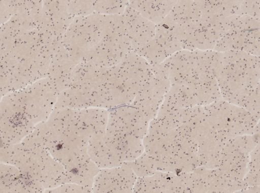 Wuchereria bancrofti