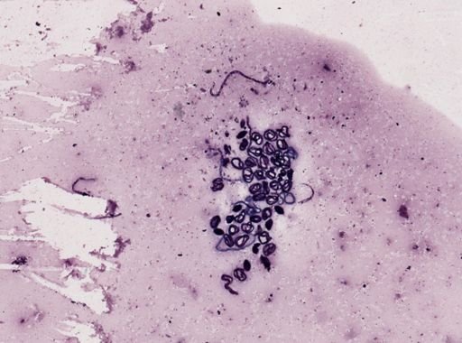 Onchocerca volvulus