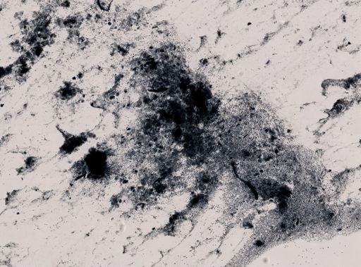 Entamoeba gingivalis