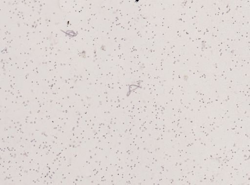Wuchereria bancrofti