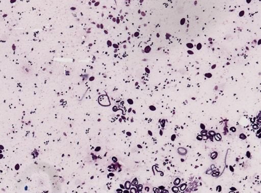 Onchocerca volvulus