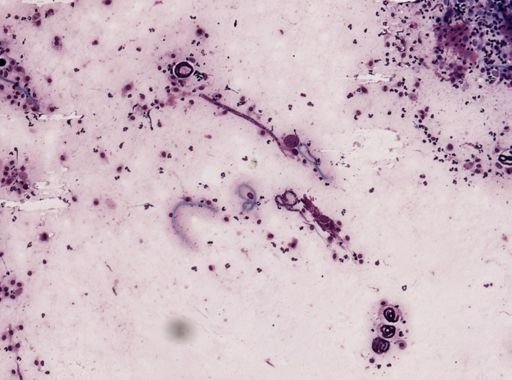Onchocerca volvulus
