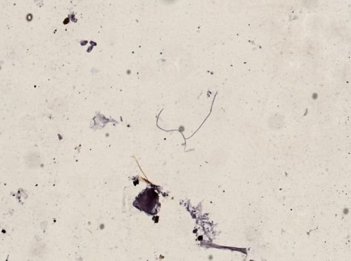 Onchocerca volvulus