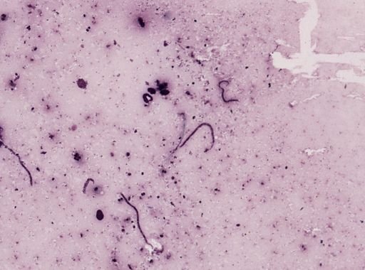 Onchocerca volvulus