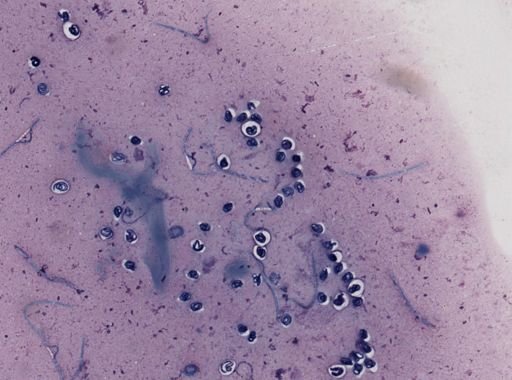 Onchocerca volvulus