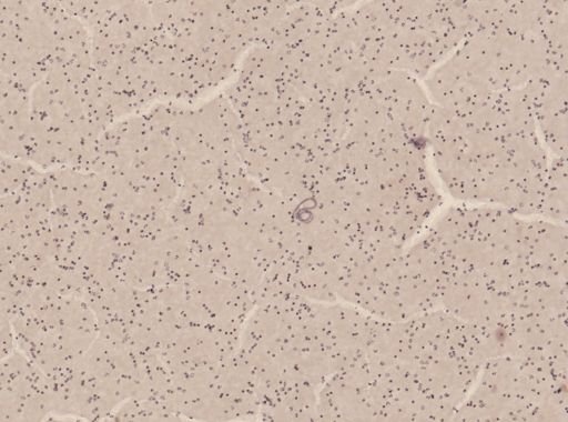 Wuchereria bancrofti
