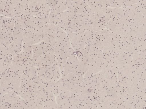 Wuchereria bancrofti