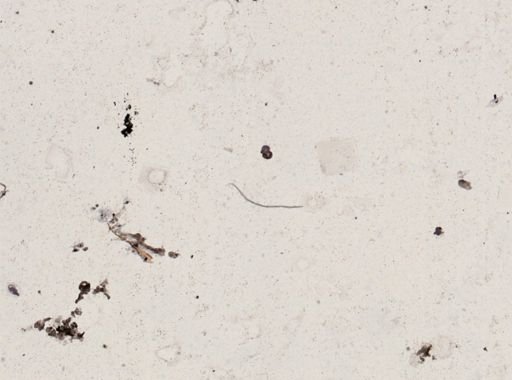Onchocerca volvulus