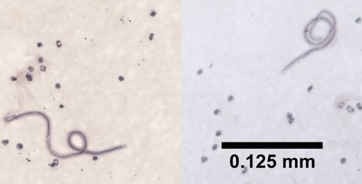Wuchereria bancrofti