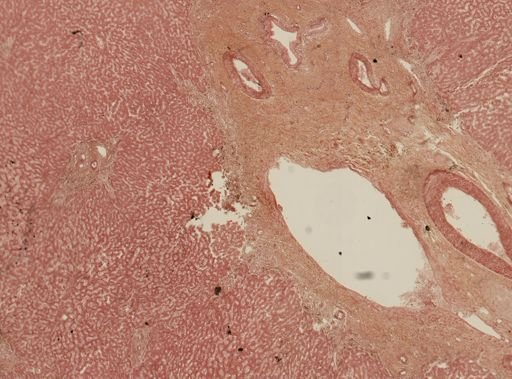 Entamoeba histolytica