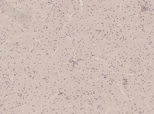Wuchereria bancrofti