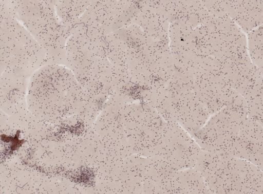 Wuchereria bancrofti