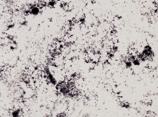 Entamoeba gingivalis