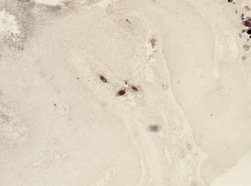Schistosoma haematobium
