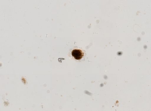 Strongyloides stercoralis
