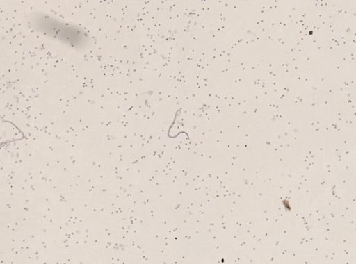 Wuchereria bancrofti