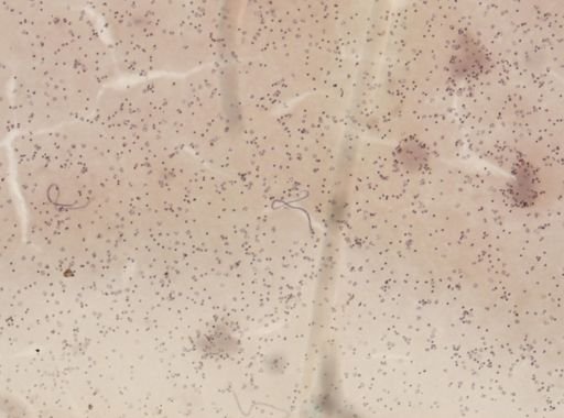 Wuchereria bancrofti