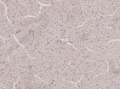 Wuchereria bancrofti