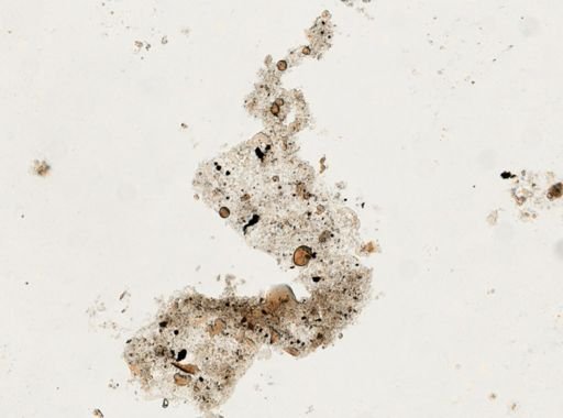Paragonimus westermani