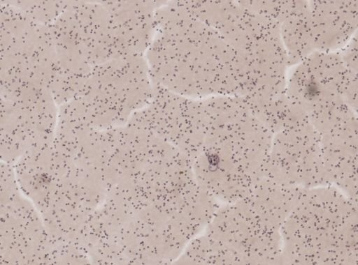 Wuchereria bancrofti