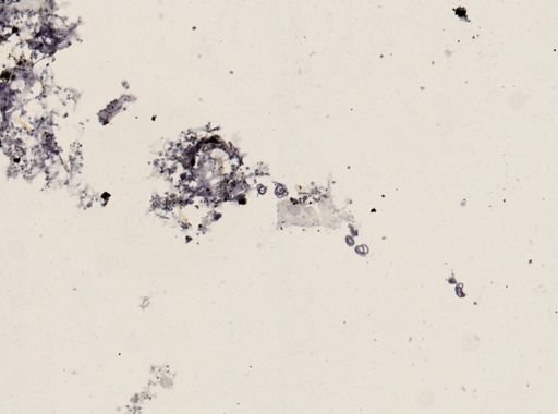 Onchocerca volvulus