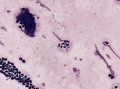 Onchocerca volvulus