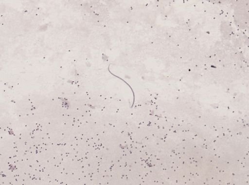 Wuchereria bancrofti