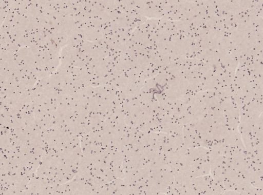 Wuchereria bancrofti