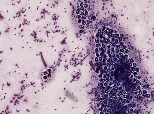 Onchocerca volvulus