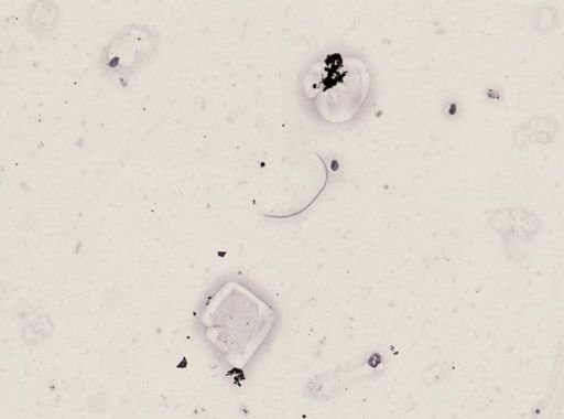 Onchocerca volvulus
