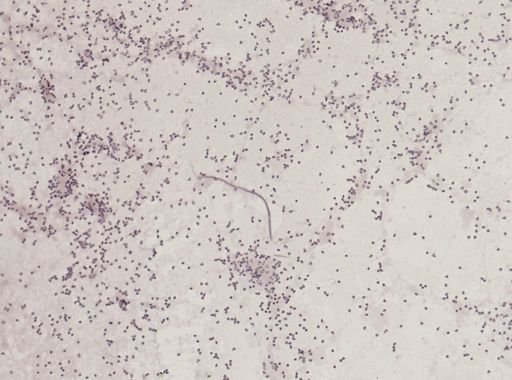 Wuchereria bancrofti