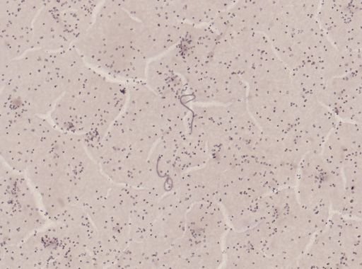 Wuchereria bancrofti