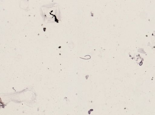 Onchocerca volvulus