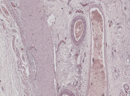 Entamoeba histolytica