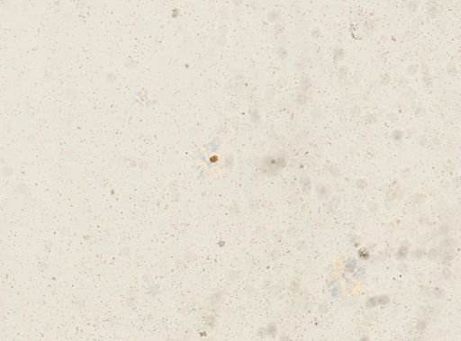 Schistosoma haematobium