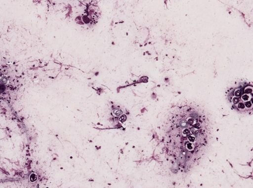 Onchocerca volvulus