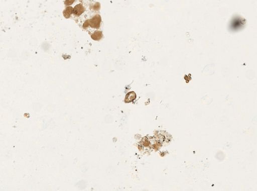 Paragonimus westermani