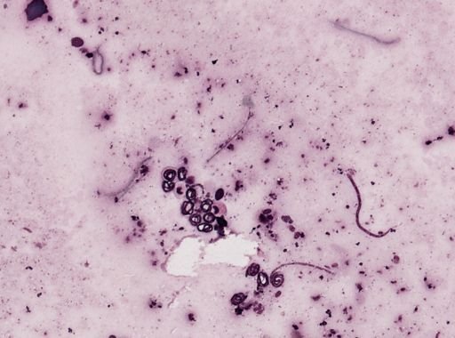 Onchocerca volvulus