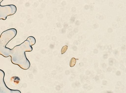 Paragonimus westermani
