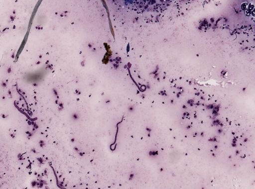 Onchocerca volvulus