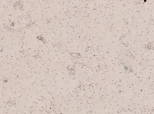 Wuchereria bancrofti