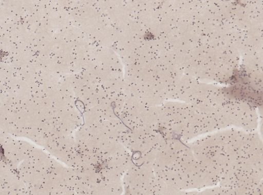 Wuchereria bancrofti