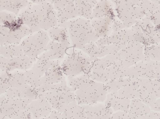 Wuchereria bancrofti