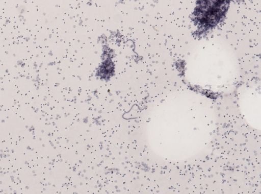 Wuchereria bancrofti