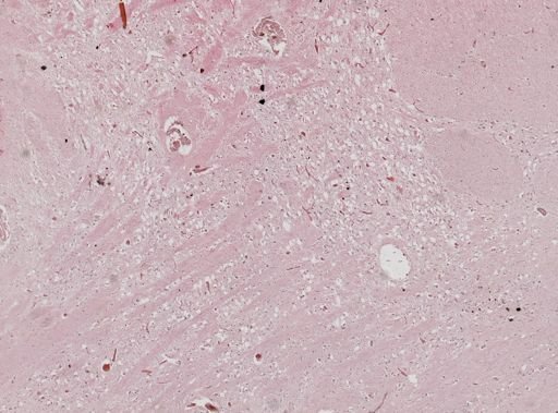 Plasmodium falciparum
