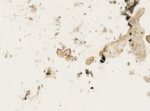 Paragonimus westermani