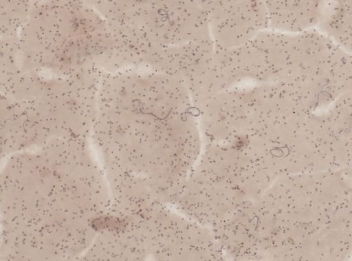 Wuchereria bancrofti
